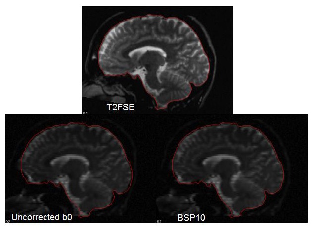 Good correction in the sagittal plane